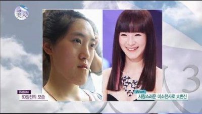 ​韩国整容节目叫什么，韩国整容过程(韩国整容综艺节目视频)